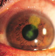 Endothelialdystrophy