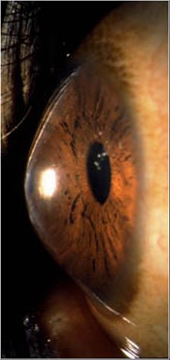 Keratoconus